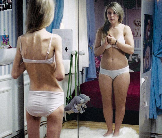 Anorexie femme