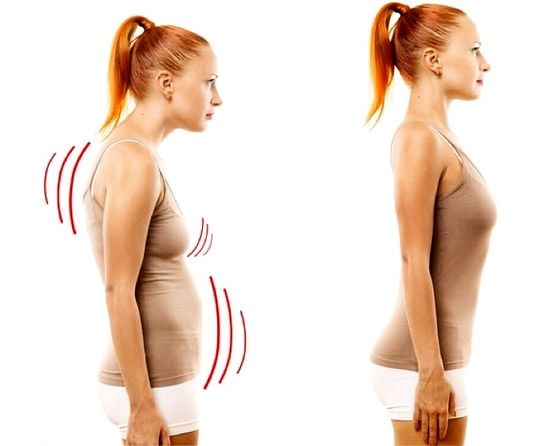 Posture Diastasis
