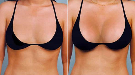Seins grossir