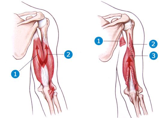 Les 3 faisceaux du triceps