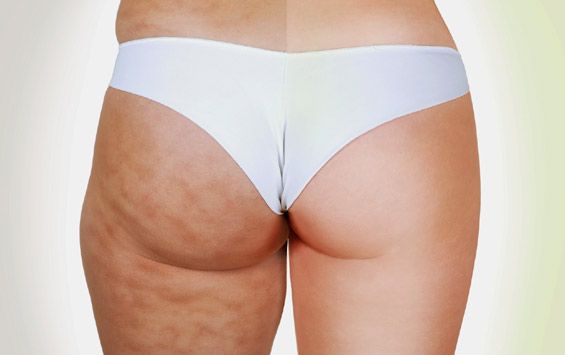 Fesses cellulite